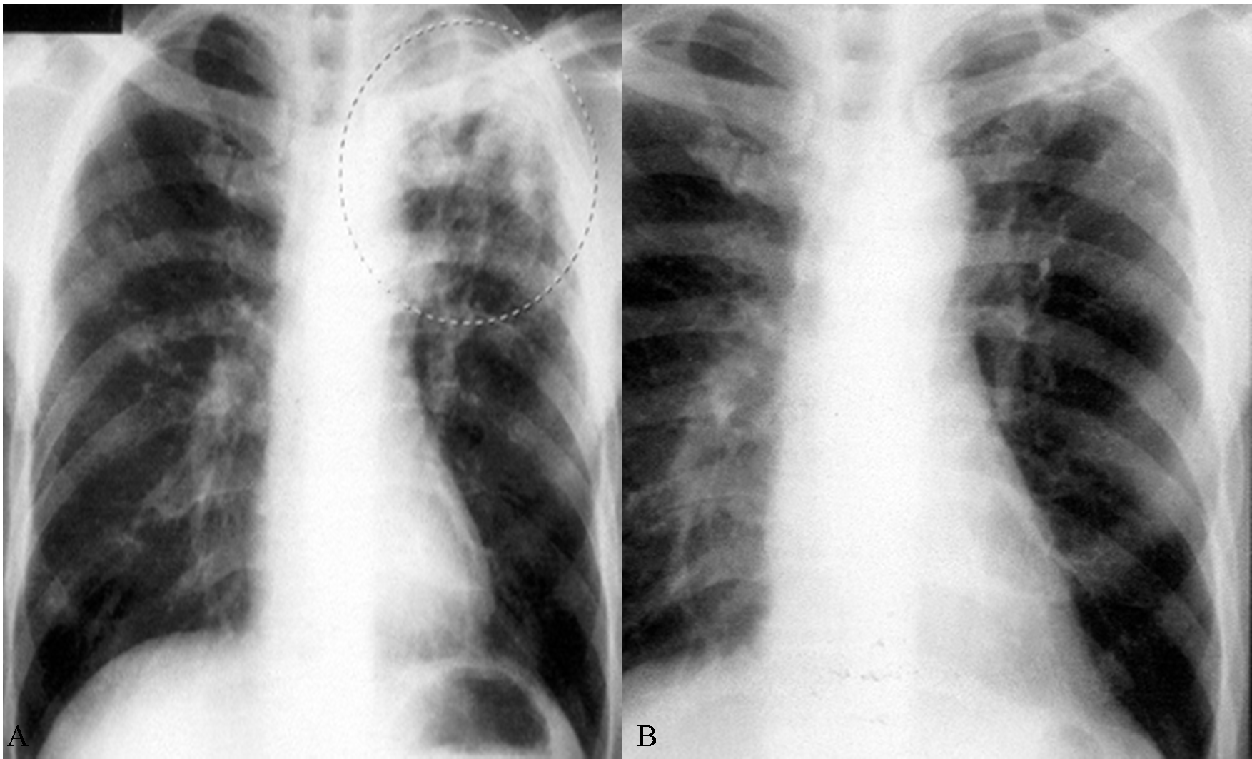 Легкие человека с туберкулезом. Открытая и закрытая форма туберкулеза. Туберкулез (легкая форма), ремиссия. Туберкулез легких рентген.