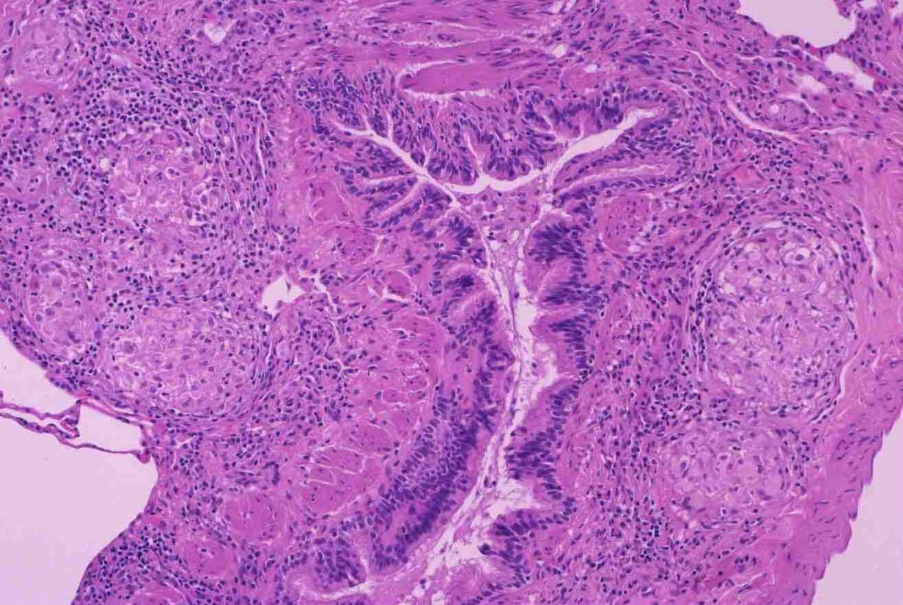 can colon cancer spread to peritoneum