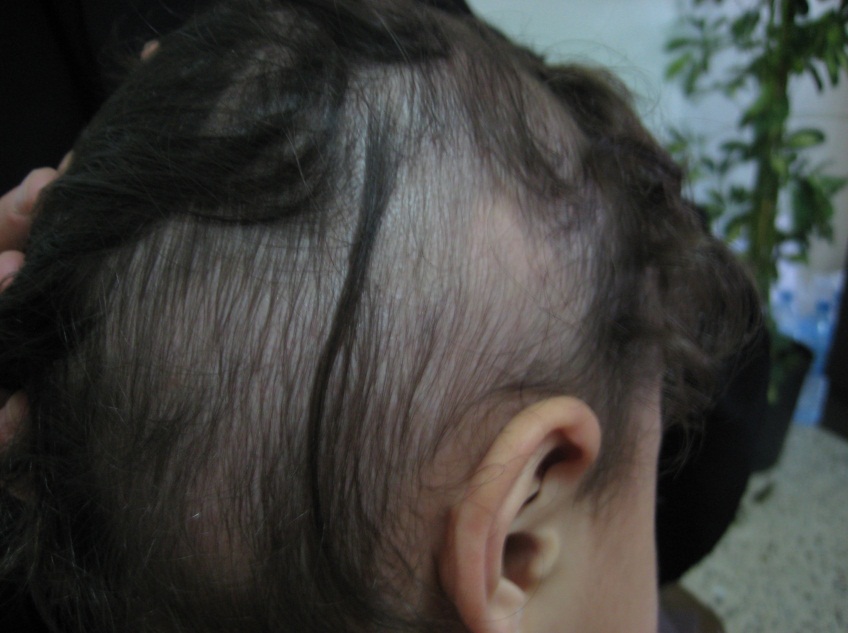 Причины выпадения волос у подростка. Очаговая алопеция (alopecia Areata). Очаговая (гнездная) алопеция.
