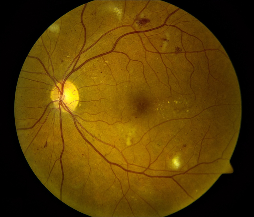 Ангиопатия сосудов сетчатки что это. Диабетическая ретинопатия сетчатки. Диабетическая ретинопатия глаз. Геморрагическая ретинопатия. Анемическая ретинопатия.