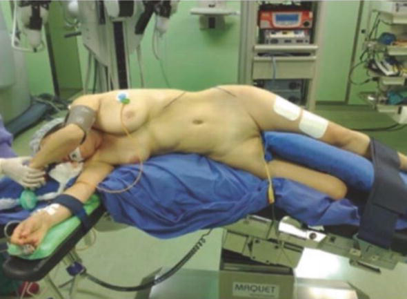 Patient’s position for transperitoneal robotic pyeloplasty. 