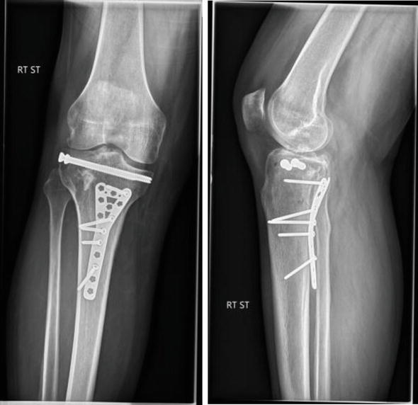 AP and lateral X-ray showing reduction and fixation of a bicondylar tibial plateau...
